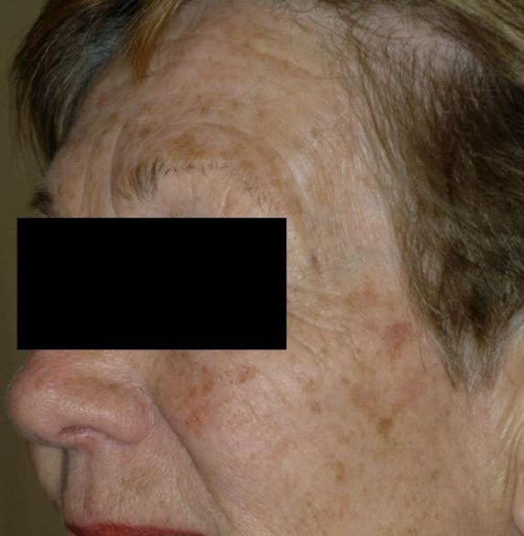 Altersflecken lasern 1