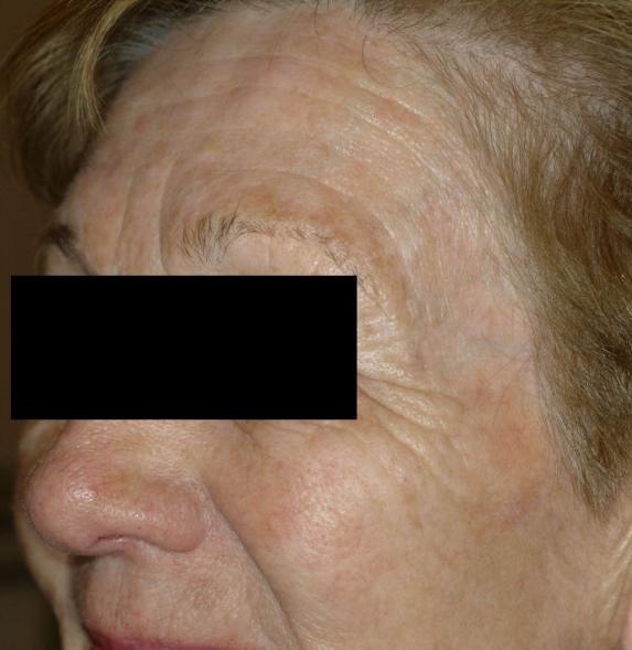 Altersflecken lasern 2