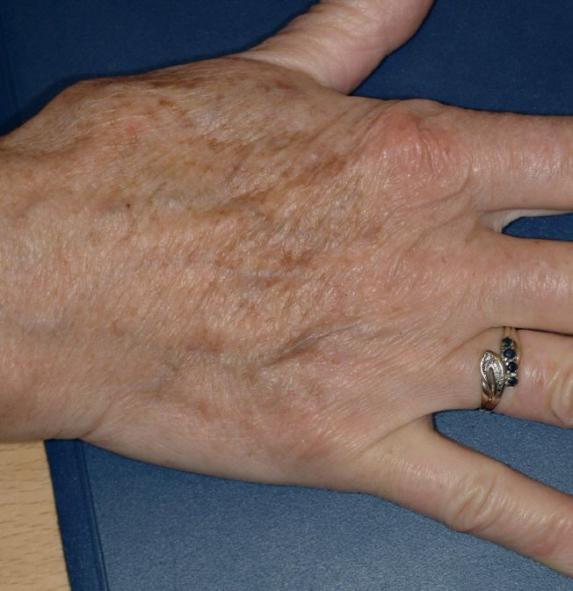 Laser Altersflecken 6