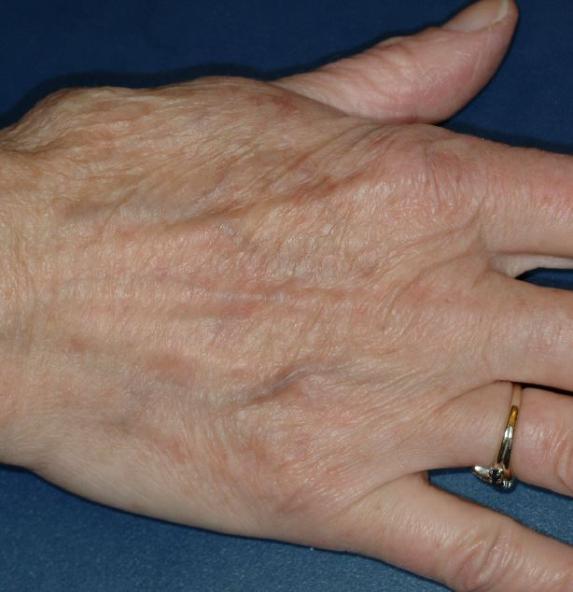 Laser Altersflecken 7