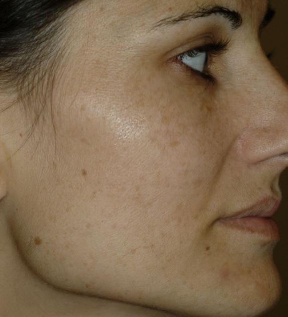 Laser Altersflecken 3