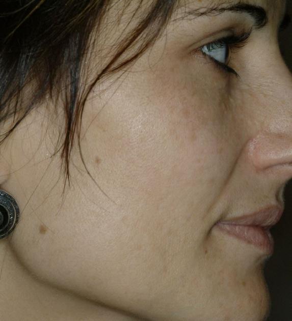 Laser Altersflecken 4