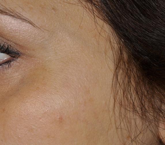 Pigmentfleck12 nachher