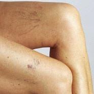 Lasertherapie Besenreiser