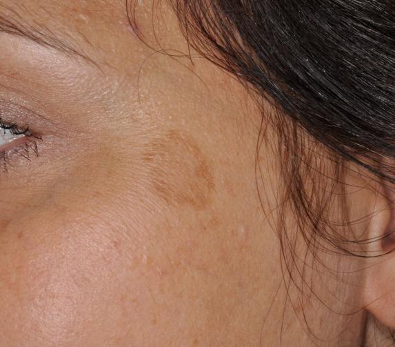 Pigmentfleck12 vorher