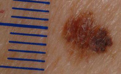 Melanoma in situ (Melanomvorstufe)