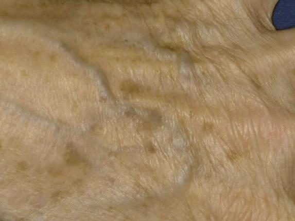 Laserentfernung Altersflecken